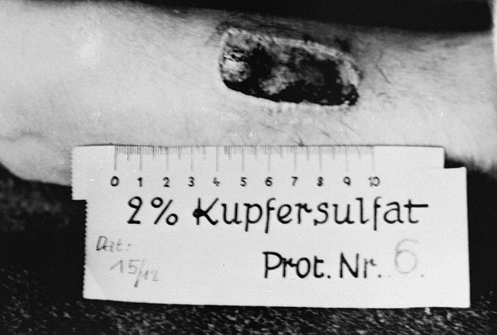 Arm of a Ravensbrück Concentration Camp phosphorus burn experimentation victim, Nov 1943; this photo was used as evidence in the Doctor's Trial of the Nuremberg Trials