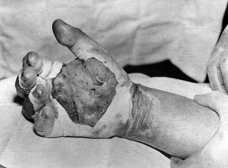 American physicist Harry Daghlian's radiation-burned right hand, 29 Aug 1945